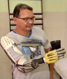 Brasileiro fabrica sua própria prótese de braço usando sucata e criatividade